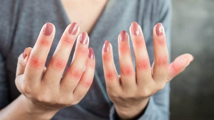 Lupus and Heart Disease