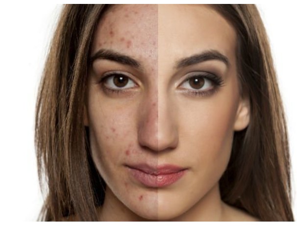 basal cell Carcinoma treatment Irvine CA