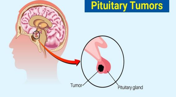 Living With a Pituitary Tumor: Managing Symptoms and Finding Support in Kolkata