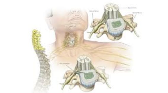 Cervical Spine Neurosurgery in Kolkata: Advanced Solutions for Neck Pain