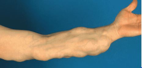 dermal fillers Irvine CA