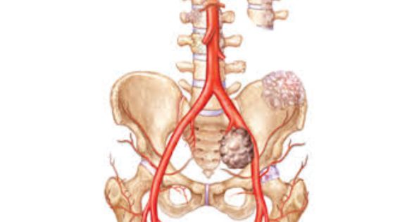 Spine Tumor Treatment by Spine Neurosurgeon in India: Advanced Care