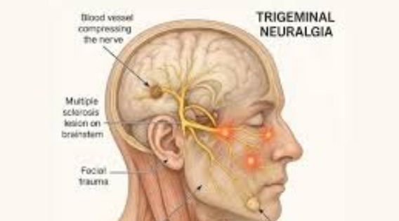 Trigeminal Neuralgia Kolkata: Advanced Interventional Pain Management
