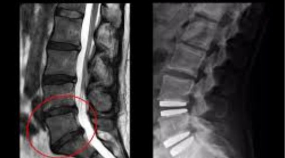 Disc Replacement India: Consult the Best Cervical Spine Surgeon in India