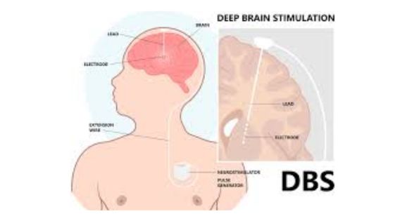 Life after DBS Surgery: DBS for Advanced Parkinsons’ Disease India Care and Treatment