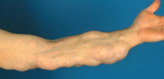 wrinkles treatment Costa Mesa CA