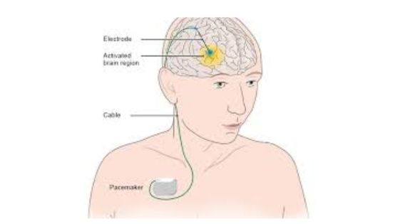 Brain Pacemaker India: Deep Brain Stimulation (DBS) Surgery in Kolkata