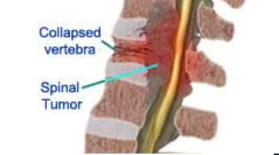 Spinal Tumor Treatment in India: Expert Surgery & Recovery