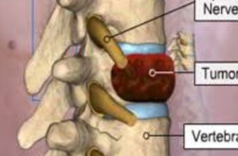 Spine Tumor Surgery in India: Consult Top Spine Neurosurgeon in Kolkata, India