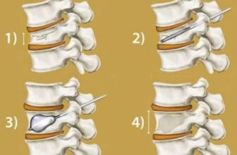 Vertebroplasty and Kyphoplasty Recovery Time in the Elderly: What to Expect