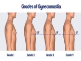 Gynecomastia and its surgery in India