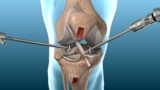 Anterior Cruciate Ligament ACL Reconstruction