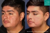 Laser Acne Scar Treatment – Vadodara