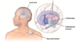 Deep Brain Stimulation (DBS) in Kolkata: A Hope for Advanced Parkinson’s Patients