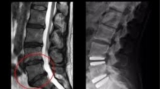 Disc Replacement India: Consult the Best Cervical Spine Surgeon in India