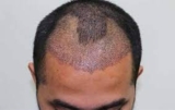Side Effects And Risks Of Hair Transplantation Surgery