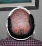 What Are The Important Factors For Hair Successful Hair Transplantation?