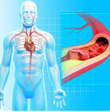 Peripheral Vascular Disease- Dr.Jatin’s Vein center