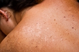 Skin cancer is deadly for health