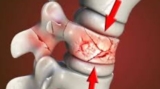 Spine Fracture Treatment in Kolkata: Vertebroplasty and Kyphoplasty Recovery Time in the Elderly