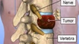 Spine Tumor Surgery in Kolkata: Contact the Best Spine Neurosurgeon in India