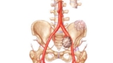 Spine Tumor Treatment by Spine Neurosurgeon in India: Advanced Care
