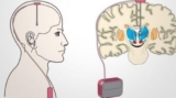 Unlocking Hope: DBS for Advanced Parkinson’s Disease in Kolkata