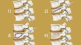 Vertebroplasty and Kyphoplasty Recovery Time in the Elderly: What to Expect