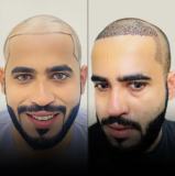 What Is The Hair Transplant Cost