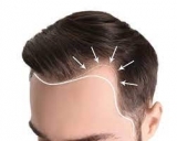 Hair Transplant and its techniques
