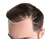 Hair transplant surgery in India