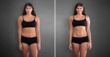 Liposuction and its surgery in India