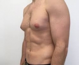 Gynecomastia Instructions you should know
