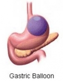 Benefits and Risks of Weight Loss Surgery
